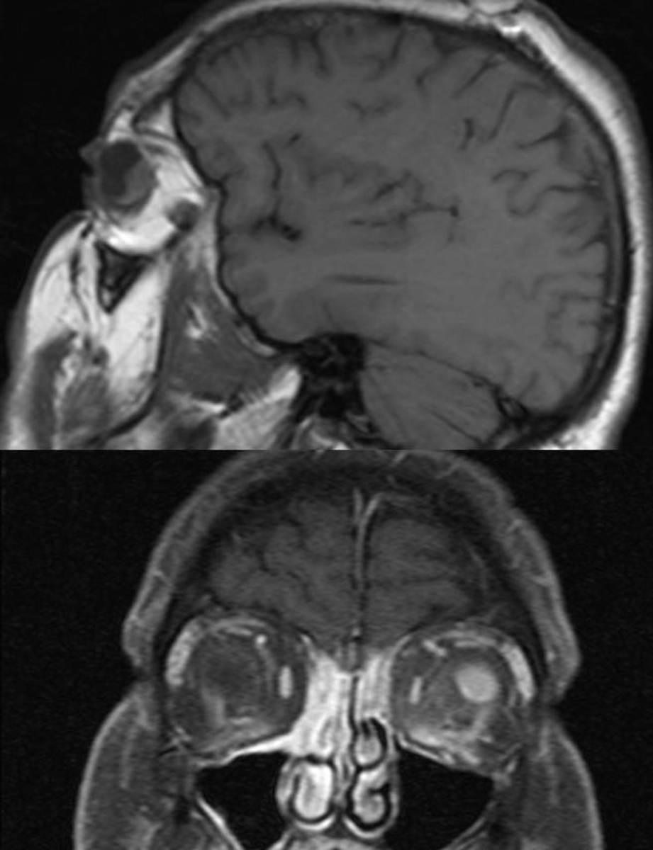 Fig. 10: Lesión sobreelevada en la cámara posterior del globo ocular izquierdo, discretamente hiperintensa en secuencias