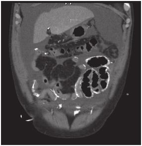 Figura 1. Corresponde a las imágenes de angiotomografía de abdomen en corte coronal y axial en donde se evidencia importante calcificación alrededor de las asas intestinales. 1A. Corte coronal 1B.