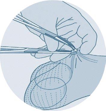 Qué es la vasectomía? Es un procedimiento quirúrgico menor, utilizado por los cirujanos para esterilizar a los hombres.