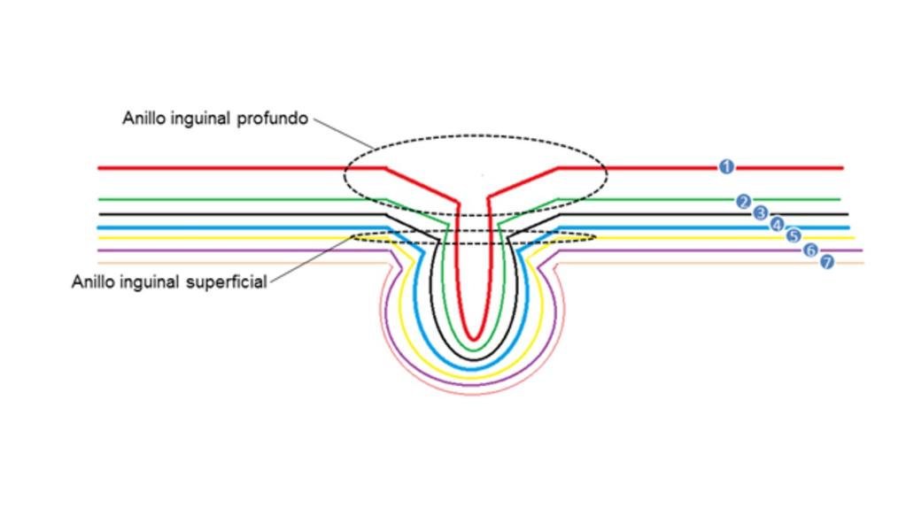 Fig. 2: Anatomía del conducto inguinal. nº 1: Peritoneo. nº 2: Fascia transversalis.
