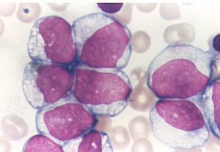 Esplenomegalia Neoplásica Sindromes linfoproliferativos: EH, linfomas, LLC, leucemia de células peludas Leucemias agudas Sindromes mieloproliferativos