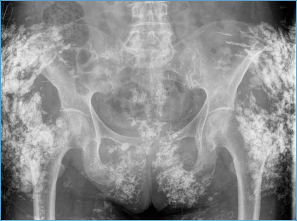 Fig. 18: Dermatomiositis: Calcificaciones en la musculatura proximal de ambas extremidades inferiores (Rx pelvis) Referencias: M. Caba Cuevas; Hospital Universitario La Princesa, Madrid, SPAIN 5.