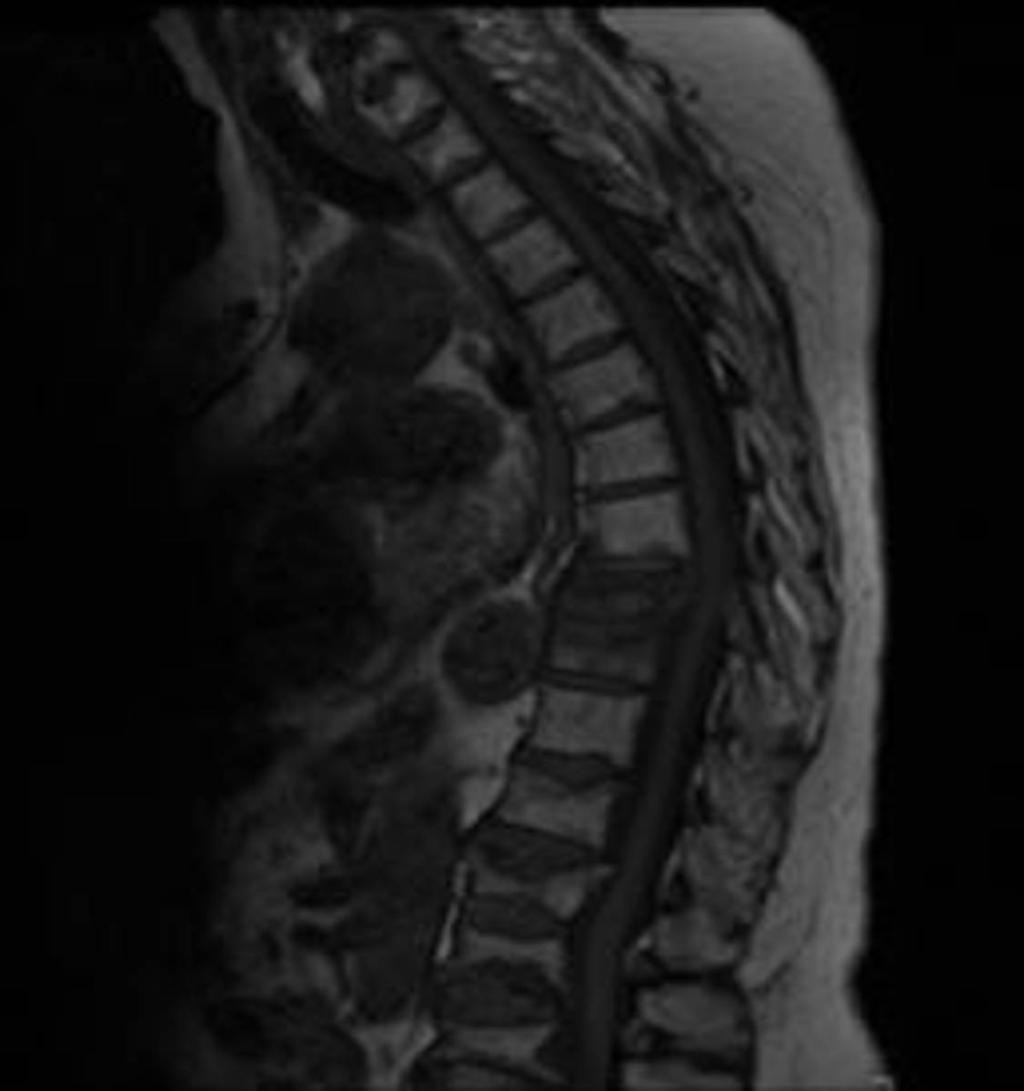 Fig. 34: RM columna dorsal.sagital T1:Fractura aplastamiento en grado severo del cuerpo vertebral T8, con patrón de edema de médula ósea en relación con fractura aguda.