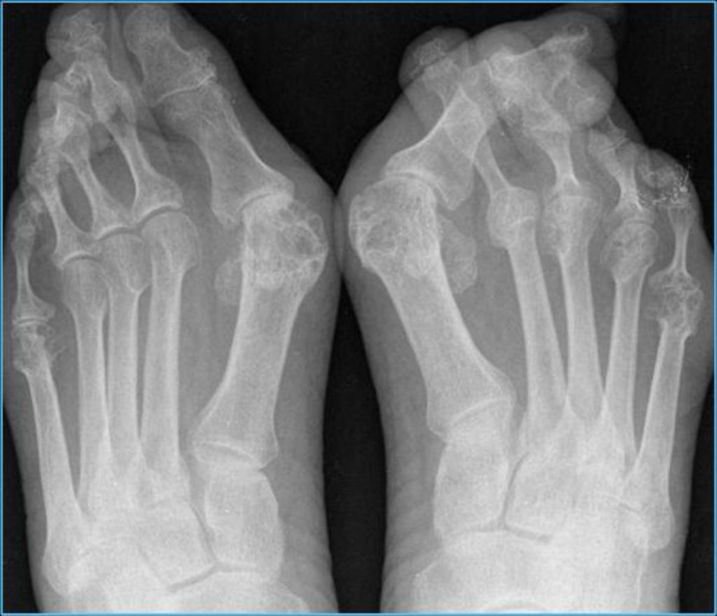 Es muy frecuente la afectación de los pies (80-90%)(figura 8) Fig. 8: Rx ambos pies: Subluxaciones de falanges proximales en dirección peroneal y cabezas de metatarsianos en plantar. Hallux valgus.