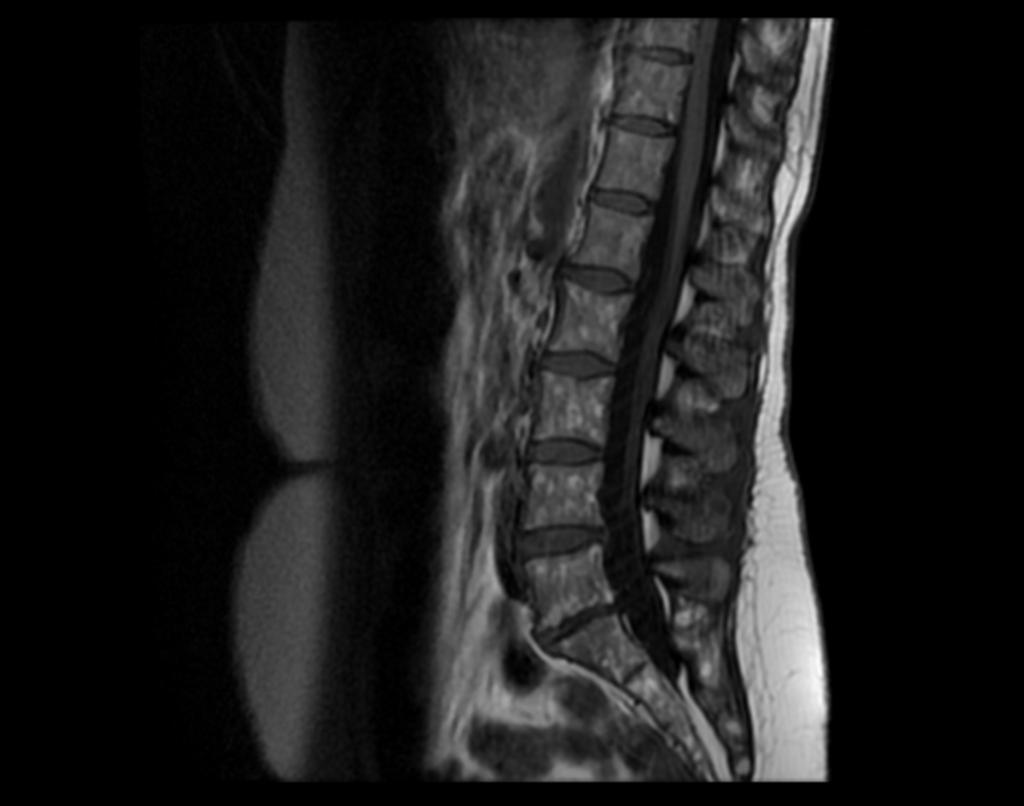 Fig. 6: Varón 51a sano. Imágenes sagitales FSET1 y T2: patrón heterogéneo con médula grasa hiperintensa en la periferia de los cuerpos vertebrales adyacente a los platillos vertebrales.