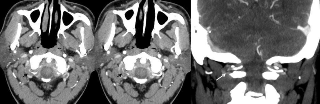 (izquierda) y coronal (derecha), donde se aprecia que el segmento V3 de la arteria vertebral derecha presenta