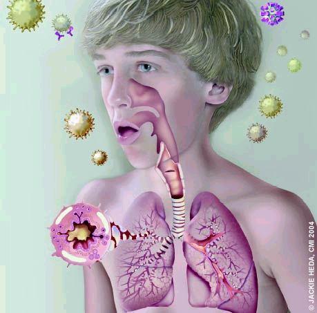 La exacerbación grave de asma es potencialmente amenazante para la vida por lo que su tratamiento requiere una correcta supervisión.