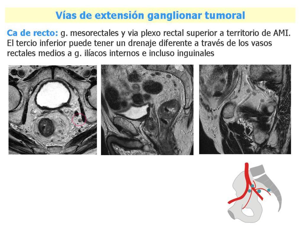 Fig. 14: Ejemplo de diseminación ganglionar de carcinoma rectal.
