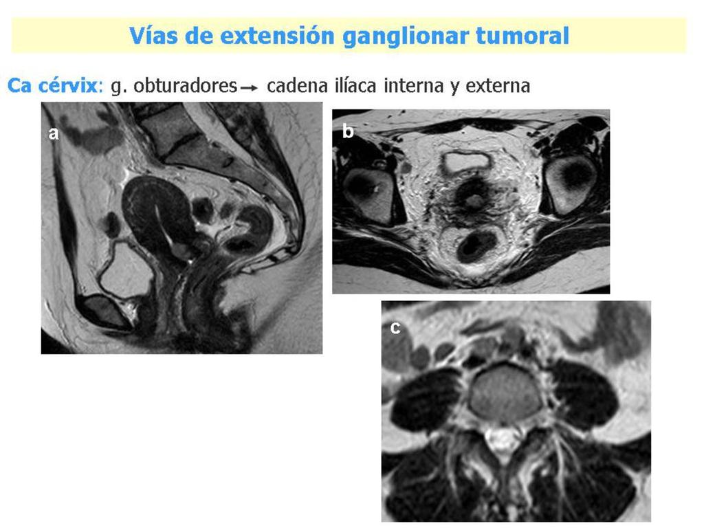 Fig. 16: a) En la imagen sagital vemos un resto postratamiento de un carcinoma de cérvix avanzado.