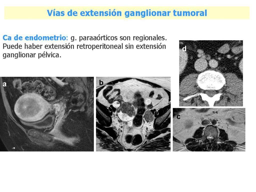 Fig. 18: a) Tumoración endometrial con infiltración del miometrio en más del 50%.