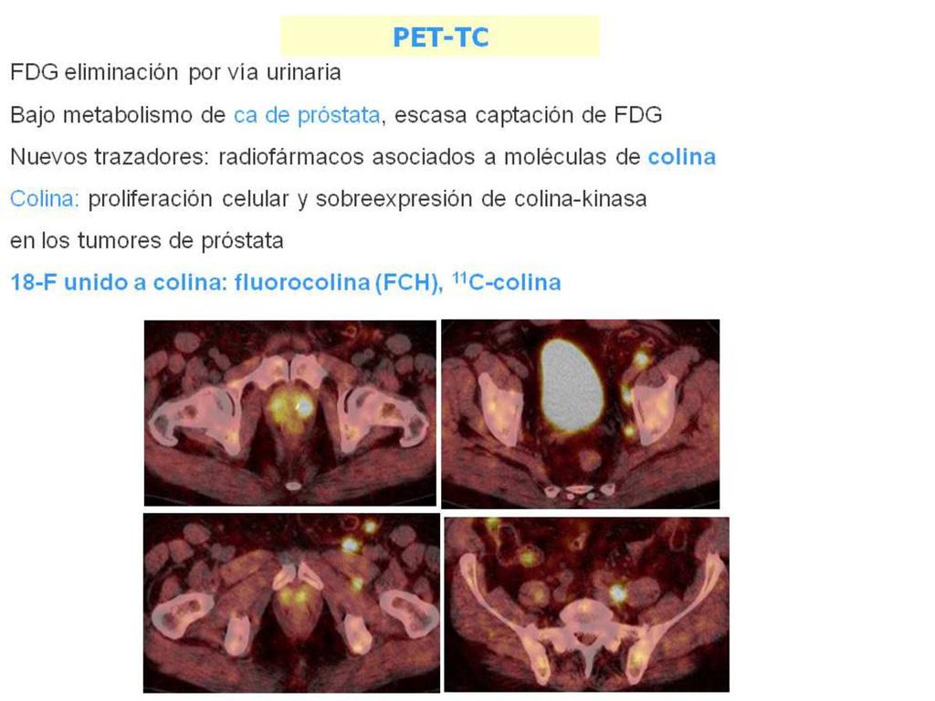 Fig. 38: PET-TC en paciente con carcinoma de cervix, adenopatias y atrapamiento ureteral. Referencias: Servicio de Medicina Nuclear. Instituto Oncológico. San Sebastián PET-TC COLINA Fig.