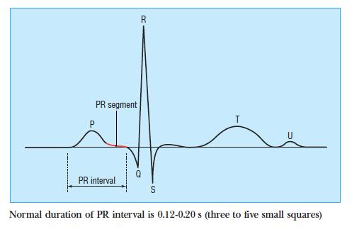 PR Intervalo entre el inicio de la depolarización auricular (P) y el inicio de la depolarización ventricular (QRS).