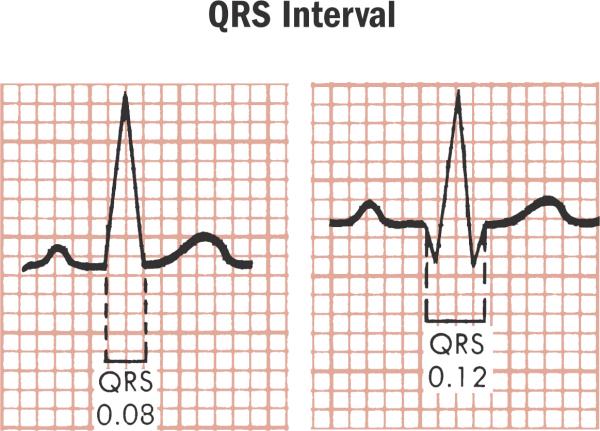 QRS Normal: 0,05 a