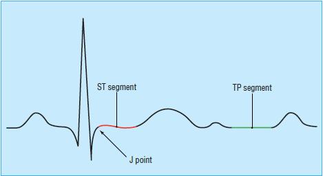 Segmento ST El QRS termina en el punto J El segmento ST comienza en el punto J y termina al final de la onda T y representa el período entre el fina de la depolarización y