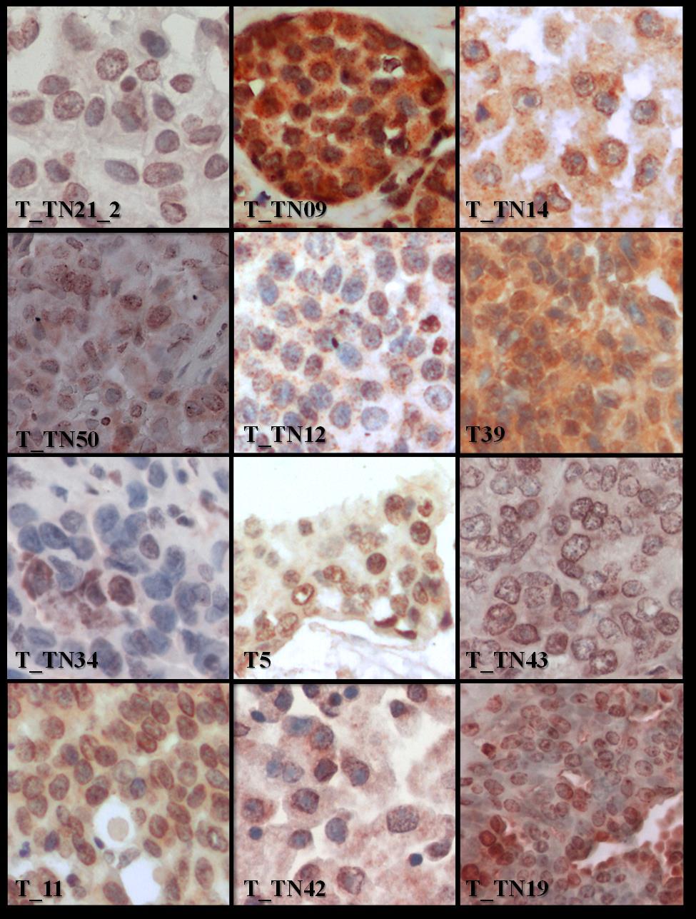 C.2). Moderada/fuerte tinción Figura 7: Imágenes de la expresión y localización de BRCA1 en los tumores TNBC.