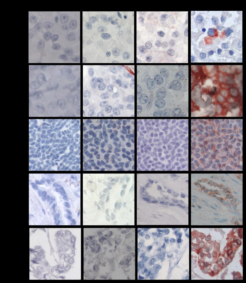 Figura 5: Expresión de las citoqueratinas 5, 14, y EGFR en los tumores TNBC.