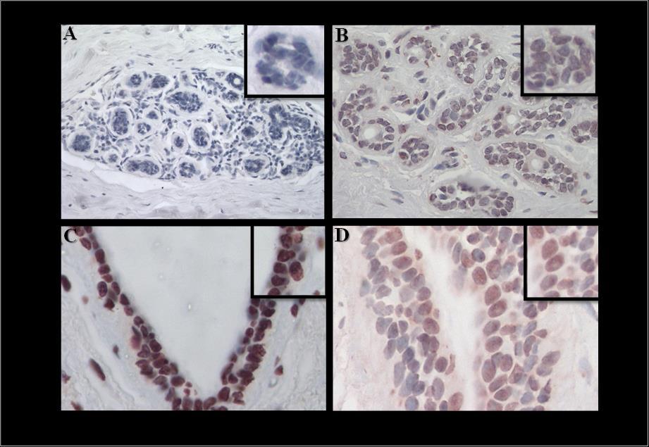 Figura 6: Imágenes de la inmunohistoquímica de BRCA1 en tejidos de mama normal, provenientes de reducciones mamarias.