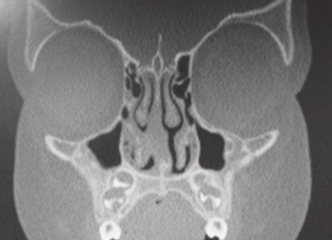 E 20-390-A-10 Cuerpos extraños en las fosas nasales, rinolitiasis Es infrecuente tener que utilizar un nasofibroendoscopio o una óptica recta, si la obstrucción nasal es posterior y no se visualiza