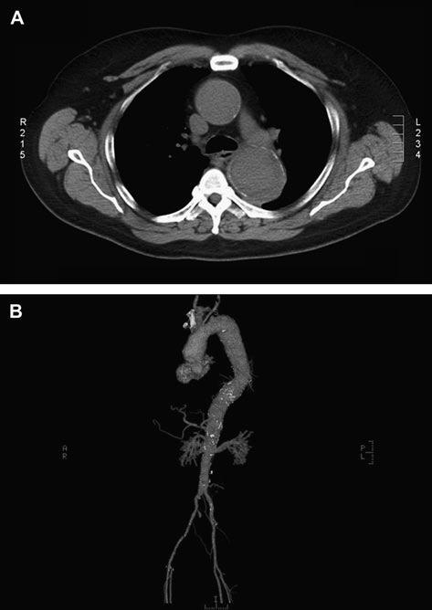 180 Abou-Zamzam et al Anales de Cirugía Vascular de aneurismas simultaneos de la aorta ascendente y del cayado 1.