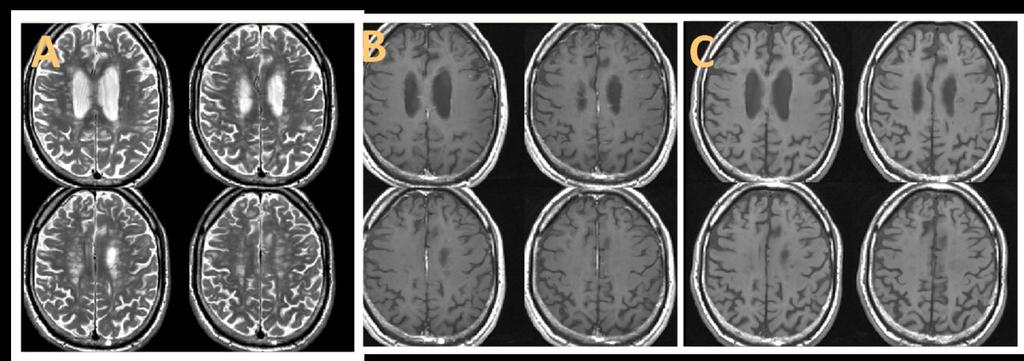 3: Ejemplo de un paciente del grupo de EMRR en el que existe una lesión captante de gd a nivel frontal izquierdo visualizada en secuencia T2 (A) y T1 con gd (B)