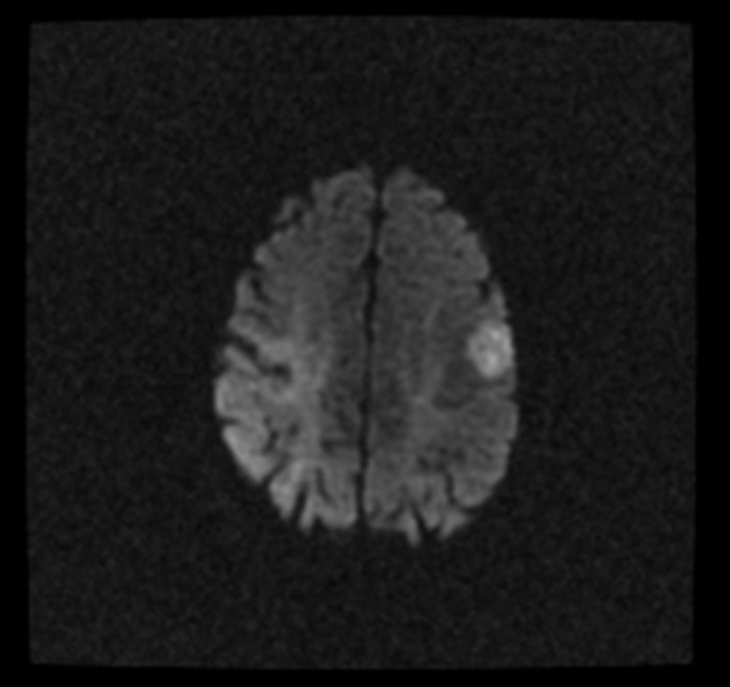 Fig. 17: Astrocitoma