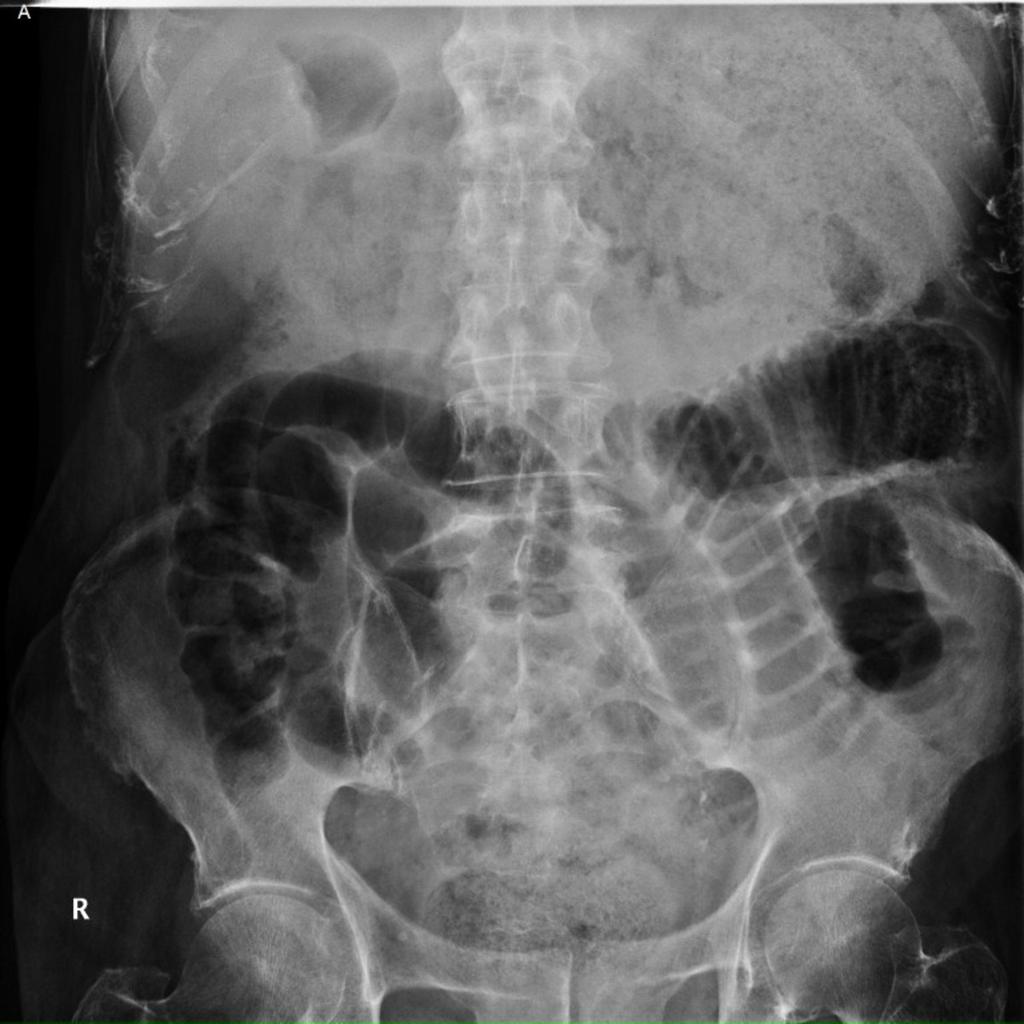 Fig. 9: Figura 4A. Bezoar gástrico e intestinal. A: Radiografía simple de abdomen.