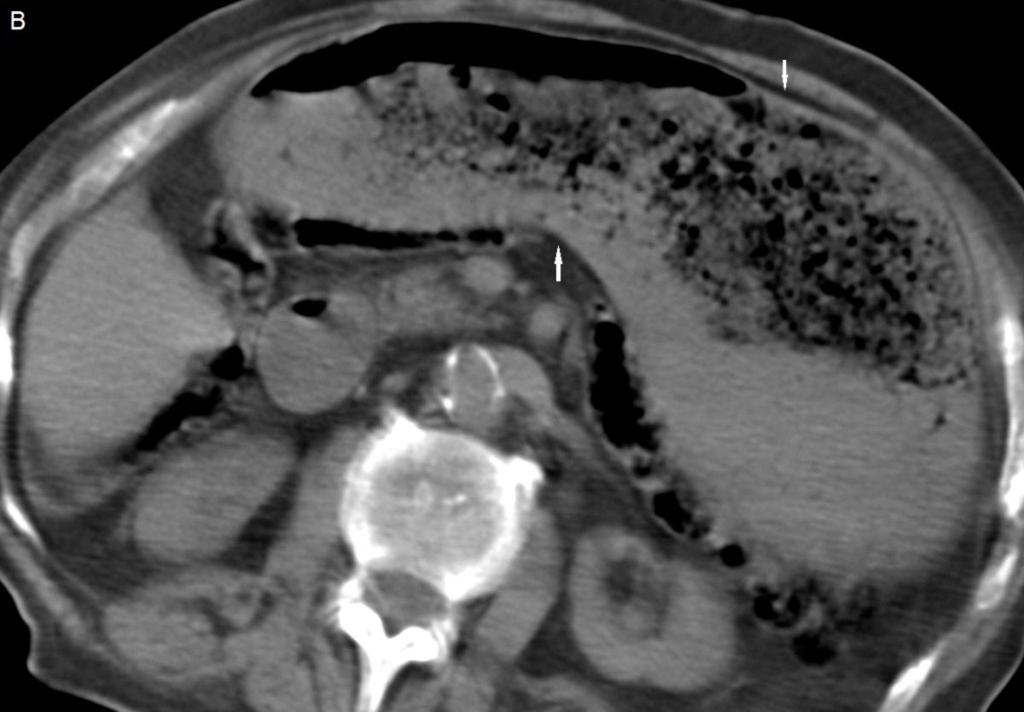 Fig. 10: Figura 4B. Bezoar gástrico e intestinal. A: Radiografía simple de abdomen.