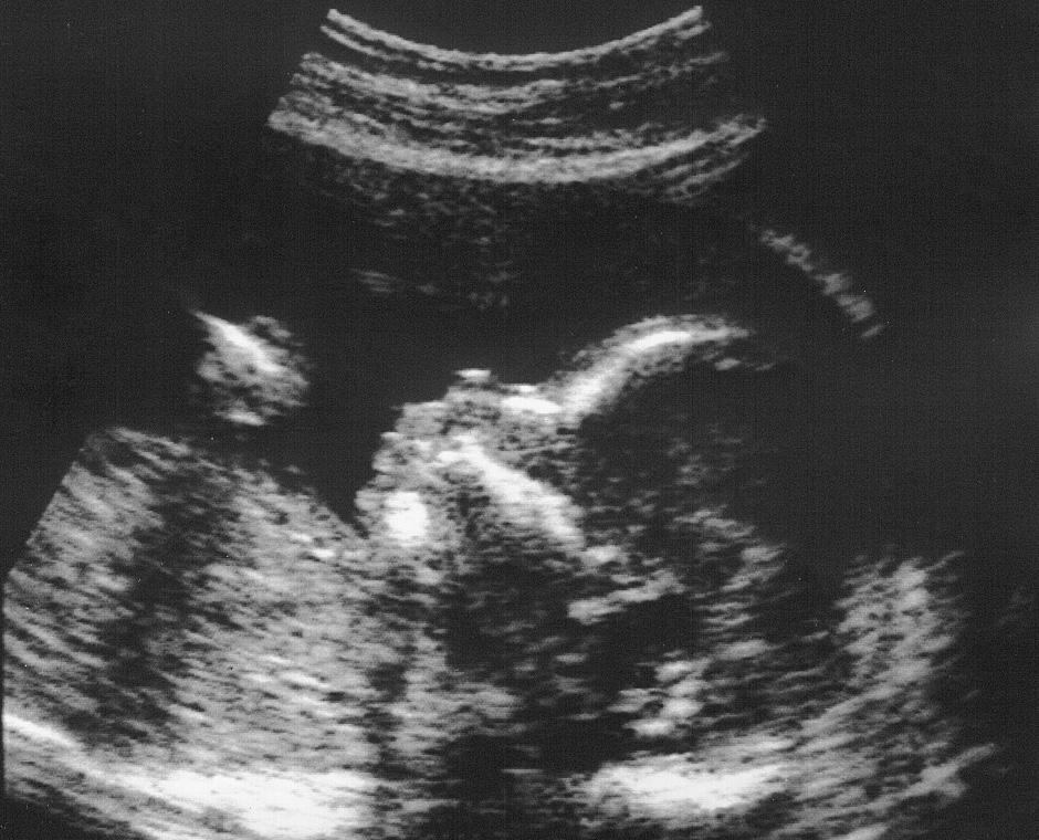 Imagen de ecografía de un feto en el útero de la madre. amniocentesis para ayudar a realizar con mayor precisión estos procedimientos.