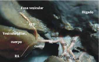 La arteria cística abordó el cuello de la vesícula dando dos ramas en 72% de los casos, una anterior y una posterior en 64 %, y una anterior y otra para la fosa vesicular en 8% de las piezas (Ver Fig.