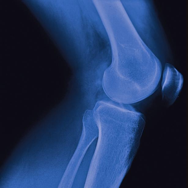 585 millones de personas sufren dolor articular producido por artrosis.