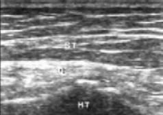 BURSITIS TROCANTEREA Imagen longitudinal: posteror a la inserción los tendones glúteos se observa una colección anecóica.