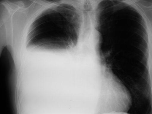 Radiografía de tórax Derrame%pleural:% J