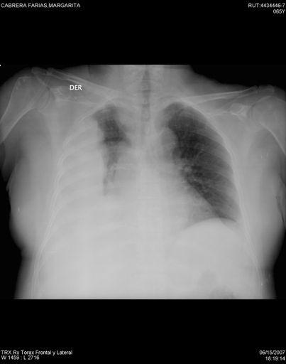 Radiografía de tórax Derrame%pleural:% J %%Imagen%%en%menisco% J J%%opacidad%homogénea% J