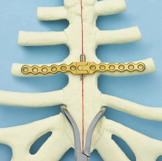 9 Colocación de la placa Coloque la placa de tal modo que permita insertar cuatro tornillos como mínimo a cada lado de la línea de fractura u osteotomía.
