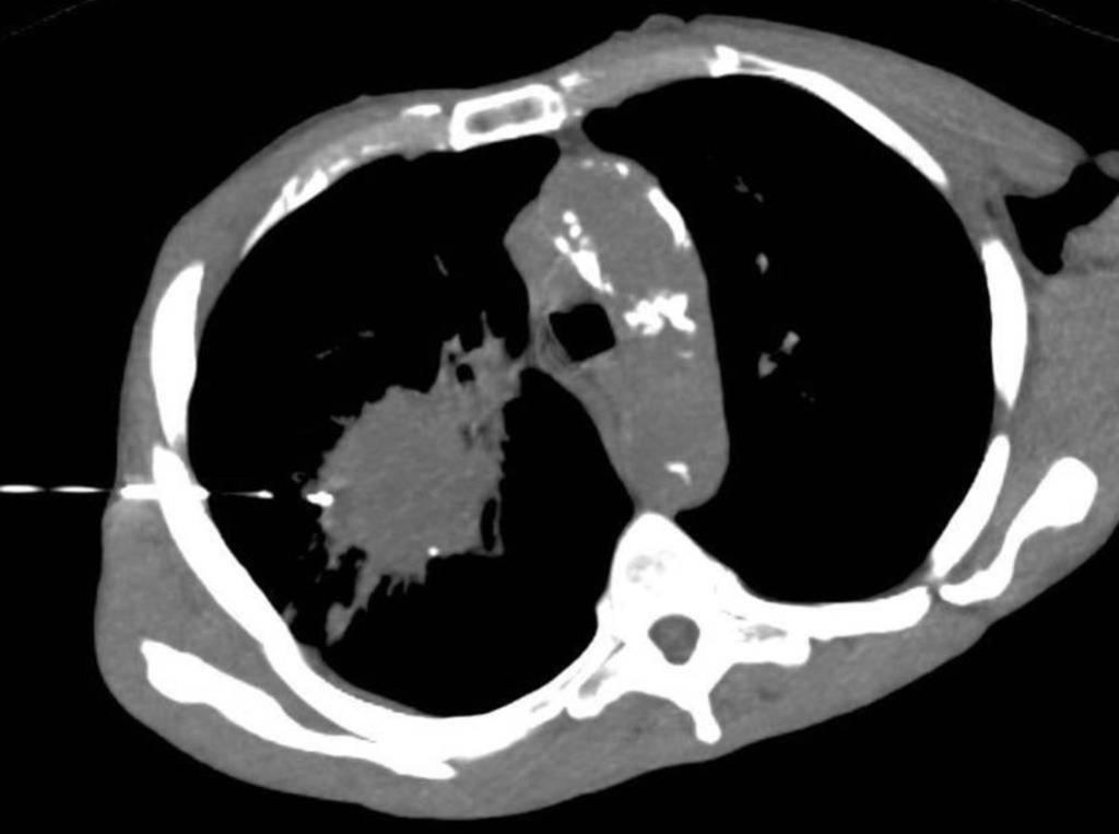 Fig. 10: Corte transversal de una TC torácica obtenida con el paciente en decúbito supino oblicuo izquierdo durante una biopsia