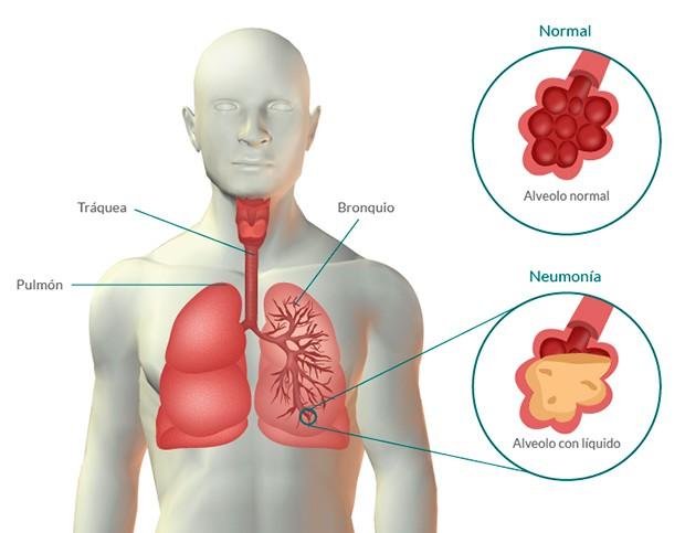 QUÉ ES? La neumonía es una infección en los pulmones que puede ser provocada por una bacteria o un virus. Afecta de modo diferente según la edad, el estado de salud general y el germen causante.