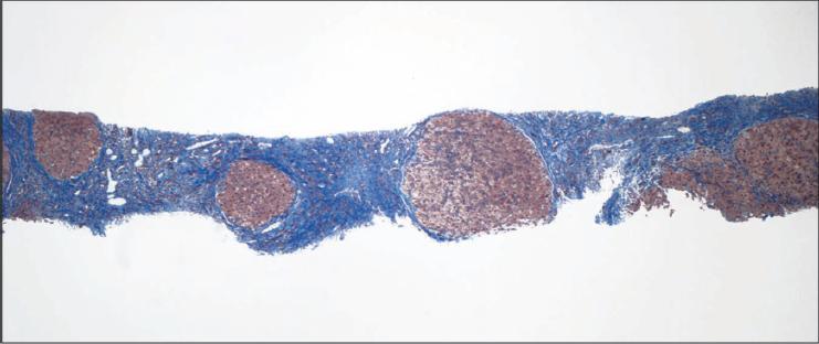 Area de fibrosis 46% HVPG 28 mmhg Biopsia hepática en