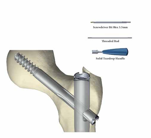 Técnica quirúrgica Tornillos cefálicos Realice una incisión sobre el extremo proximal del clavo.