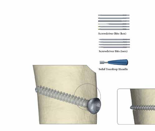 Técnica quirúrgica Técnica quirúrgica Sistema de extracción de implantes Sistema de extracción de implantes Tornillos Después de identificar el tipo y el diámetro de los tornillos, extráigalos con la