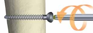 Para extraer un tornillo condíleo, monte los destornilladores necesarios: la punta de destornillador hexagonal de 6,3 mm con el mango sólido en forma de lágrima (para la tuerca) y la punta de