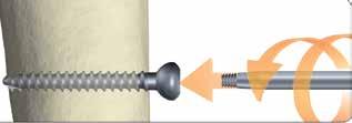 Esto puede dificultar la extracción del implante, lo que aumenta el riesgo de que la cabeza del tornillo se rompa o de que la cabeza hexagonal se estropee.
