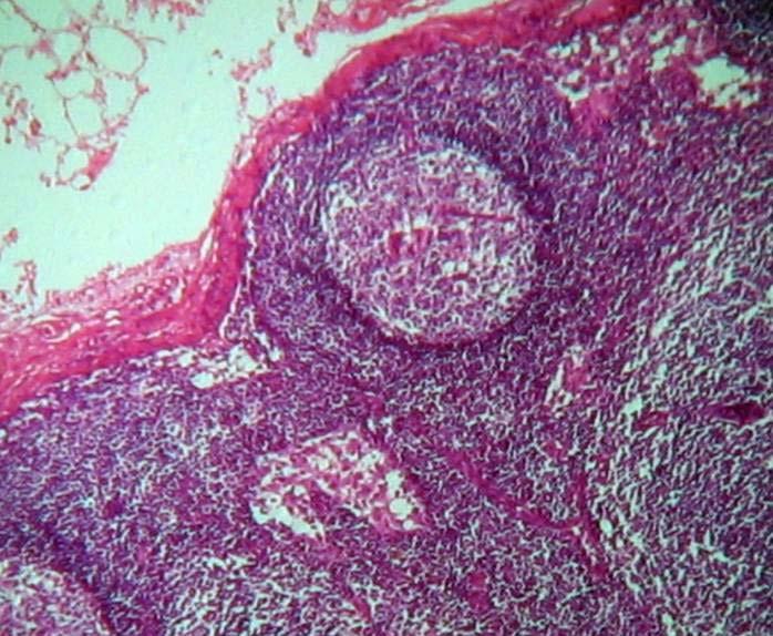 4x H/E Corteza ganglionar. Presencia de folículos linfoides y tejido linfoide difuso.