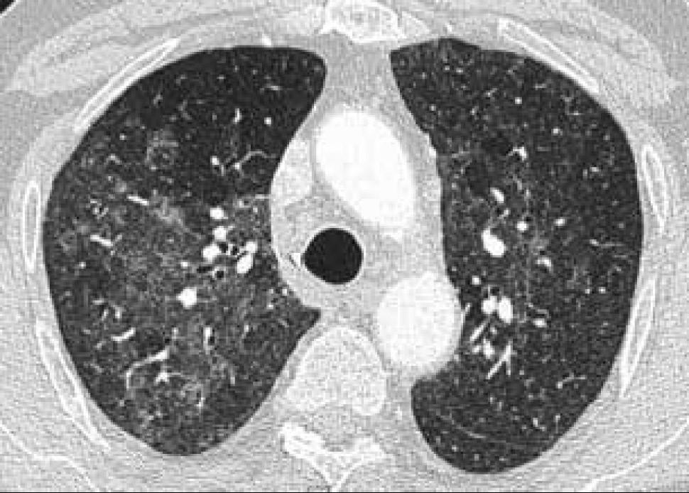 organizativa (BOOP) -Neumonía por Pneumocystis -Hemorragia alveolar difusa Fibrosis -Fibrosis pulmonar idiopática -Neumonitis por hipersensibilidad