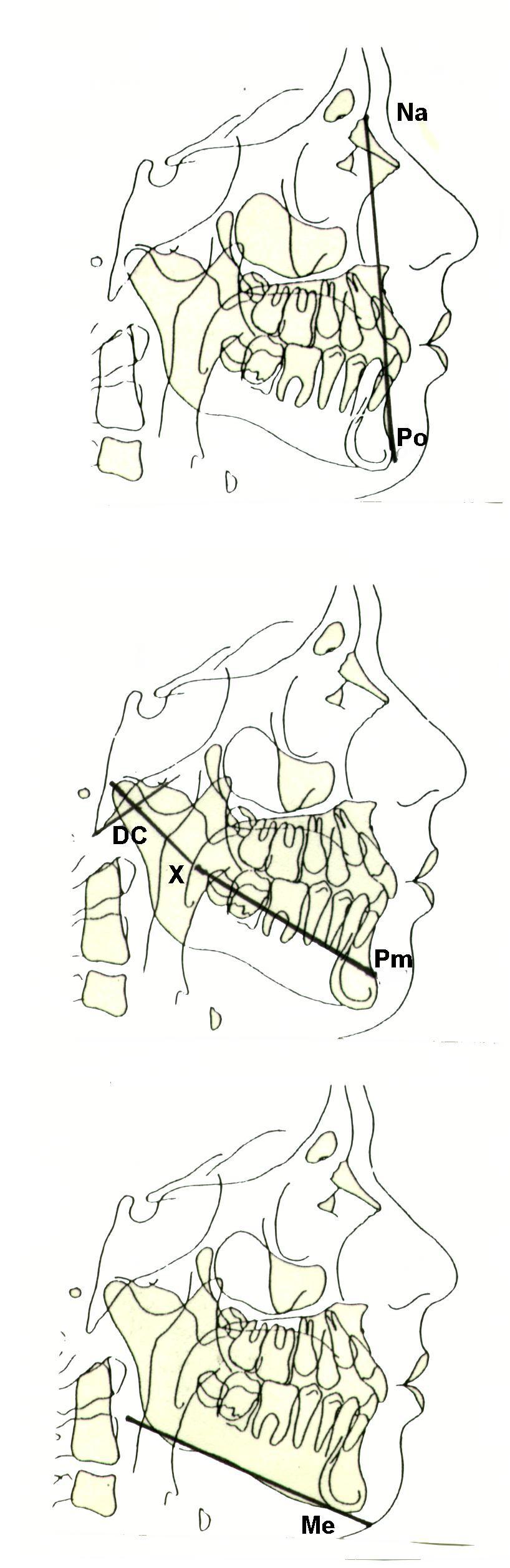 PLANO FACIAL NA - PO El plano facial permite apreciar el contorno del perfil esqueletal y de deducir su concavidad o convexidad.