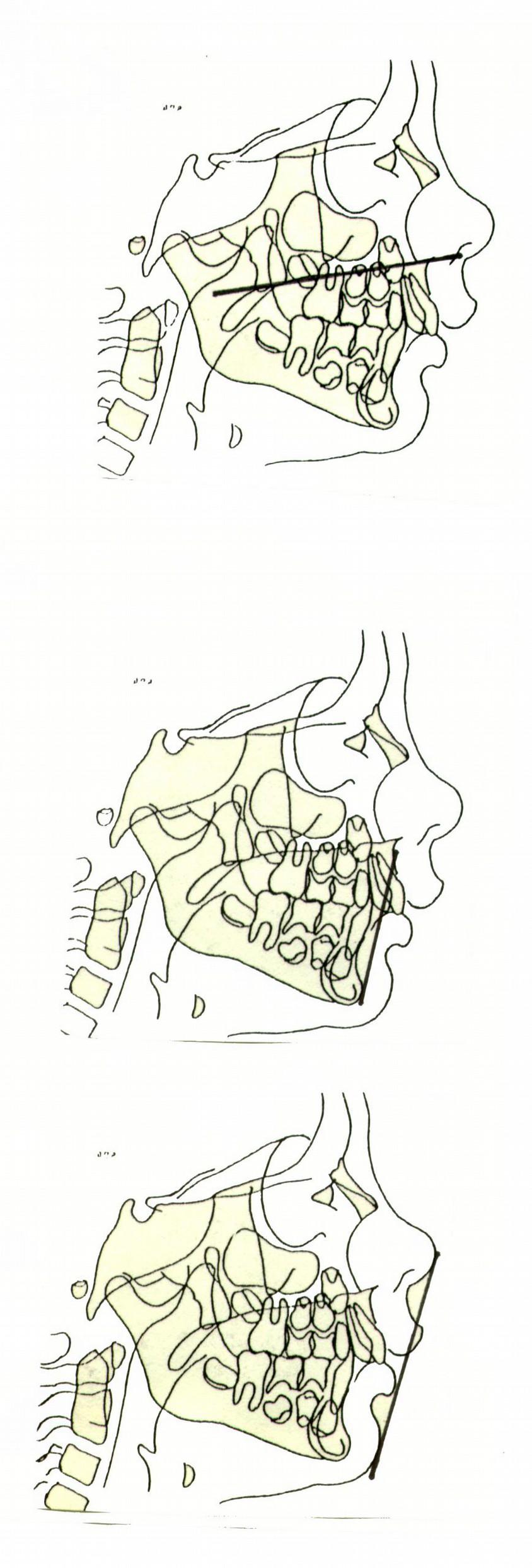 PLANO PALATINO ENA - ENP El plano palatino une la espina nasal anterior y posterior.