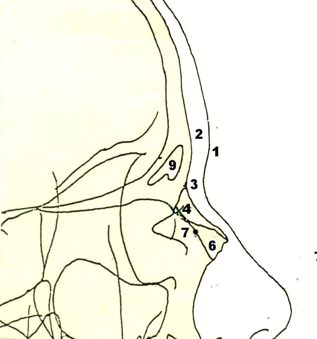 En esta zona aparece la imágen lacunar de los senos frontales,(9) comprendidos entre las corticales interna y externa del hueso frontal.