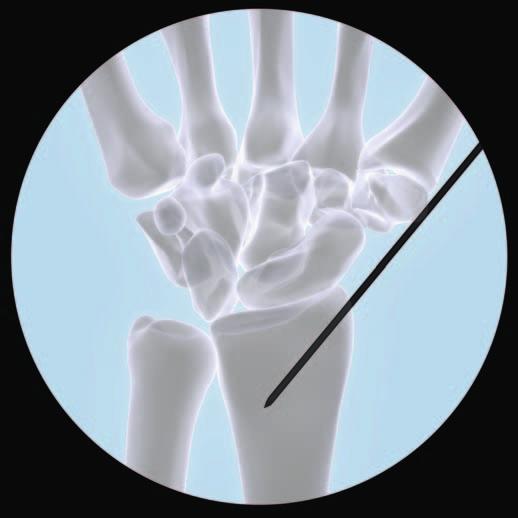 Implantación 1 Selección del Implante Seleccione las placas en función del tipo de fractura y de la anatomía del radio.