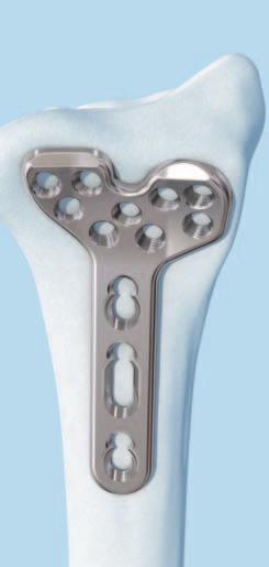 Una vez reducida la fractura, introduzca agujas de Kirschner o brocas para la estabilización provisional de la fractura.