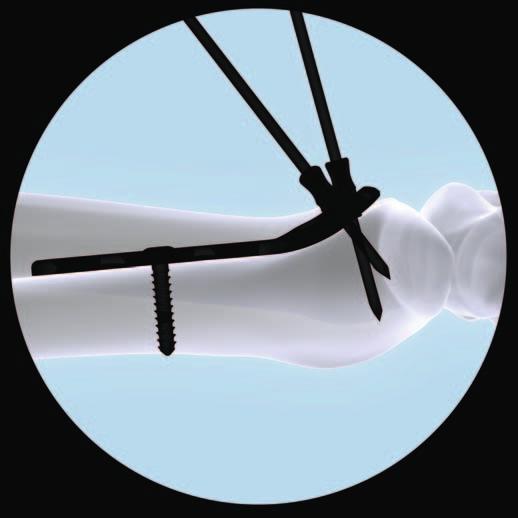 Implantación El orden de inserción de los tornillos y el uso de agujas de Kirschner pueden variar según el tipo de fractura y la técnica de reducción.