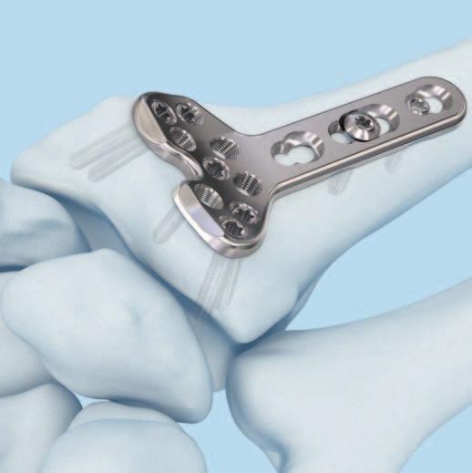 Implantación Introduzca tornillos proximales adicionales. Determine si se usarán tornillos de bloqueo o de cortical de 2.4 mm en el cuerpo de la placa.